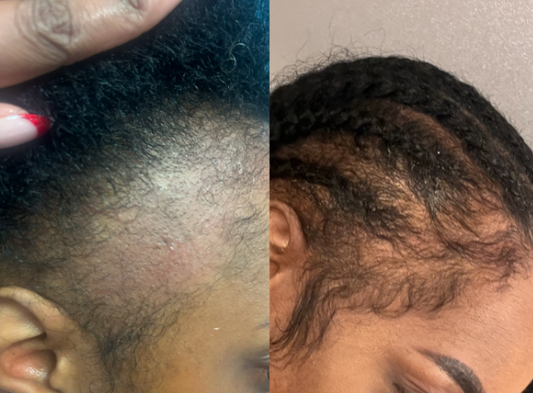 Hair Restoration: The Right Solution for You?